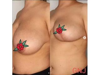 Zmniejszenie piersi - efekty