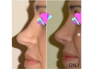 Plastyka nosa - rezultaty