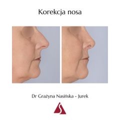 Korekta nosa - Dr Grażyna Nasińska-Jurek