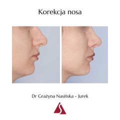 Korekta nosa - Dr Grażyna Nasińska-Jurek