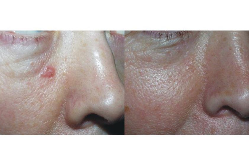 Laserowe zabiegi dermatologii estetycznej przed i po - 689867