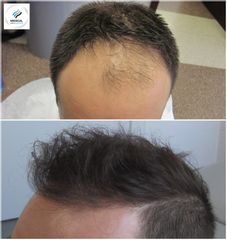 Przeszczep włosów - Medical Hair&Esthetic