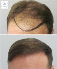Przeszczep włosów - Medical Hair&Esthetic