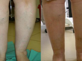 Body-jet liposukcja (WAL) - 656223