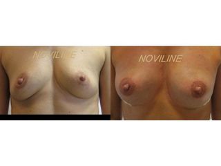 Powiększanie piersi własną tkanką tłuszczową - przed i po
