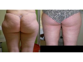 Liposukcja bryczesów - przed i po