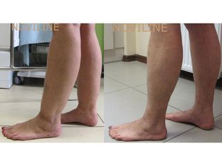Body Jet - przed i po