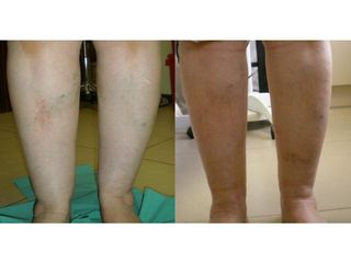 Body Jet - przed i po
