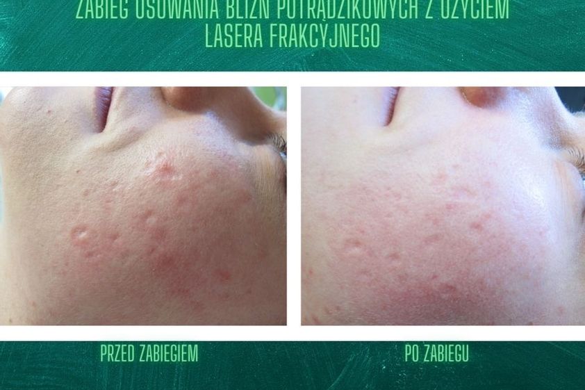Laserowe leczenie trądziku przed i po - 835262