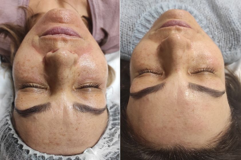 Mezoterapia igłowa przed i po - 835269
