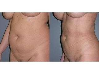 Przed i po - abdominoplastyka