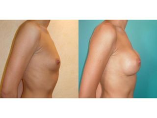 Przed i po - powiększanie biustu