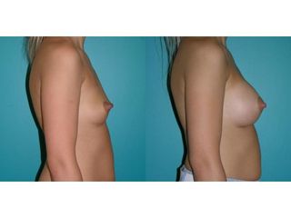 Przed i po - powiększanie biustu