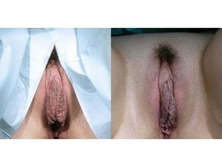 Przed i po - labioplastyka
