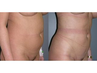 Przed i po - liposukcja