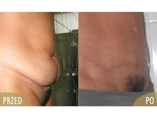 Abdominoplastyka - przed i po