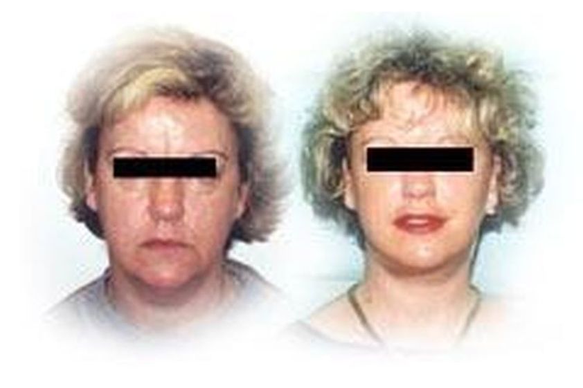 Anti-aging przed i po - 685629