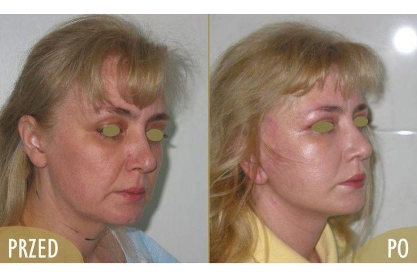 Anti-aging przed i po - 685644