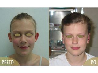 Otoplastyka - przed i po
