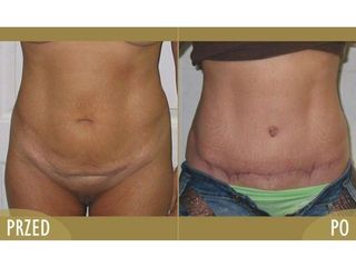 Abdominoplastyka - przed i po
