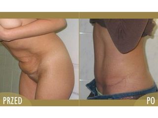 Abdominoplastyka - przed i po