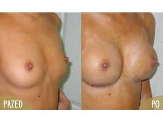 Powiększanie piersi - przed i po