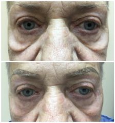 Blefaroplastyka - dr n. med. Janusz Jastrzębski
