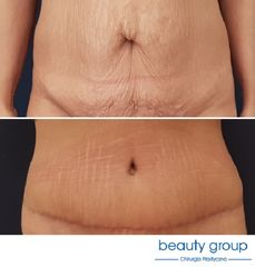 Plastyka brzucha - Beauty Group - Klinika Chirurgii Plastycznej
