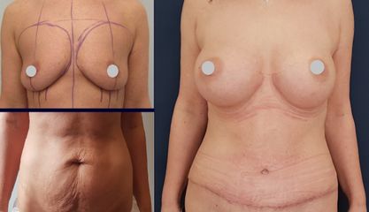 Plastyka brzucha + powiększenie piersi - Beauty Group - Klinika Chirurgii Plastycznej
