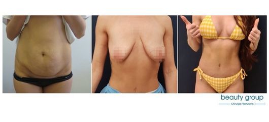 Plastyka brzucha i powiększenie piersi z plastyką - Beauty Group - Klinika Chirurgii Plastycznej