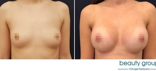 Powiększenie piersi - Beauty Group - Klinika Chirurgii Plastycznej