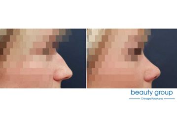 Korekta nosa - Beauty Group - Klinika Chirurgii Plastycznej