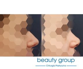 Korekta nosa - Beauty Group