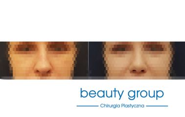 Korekta nosa - Beauty Group