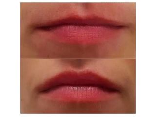 Przed i po - powiększanie ust kwasem hialuronowym