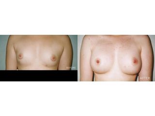 Powiększanie biustu implantami - przed i po