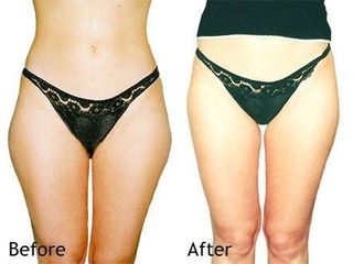 Liposukcja - Dr Jerzy M. Chęciński