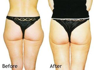 Liposukcja - Dr Jerzy M. Chęciński