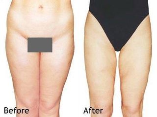 Liposukcja - Dr Jerzy M. Chęciński