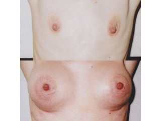 Powiększanie biustu - Dr Jerzy M. Chęciński