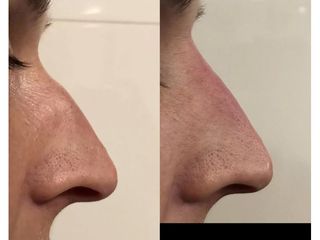 Przed i po - korekta nosa kwasem hialuronowym