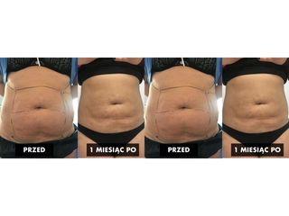 Przed i po - liposukcja brzucha