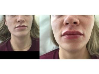 Powiększanie ust kwasem hialuronowym-689269