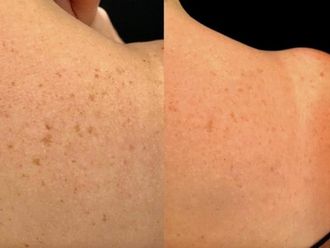 Laserowe zabiegi dermatologii estetycznej przed i po - 785938