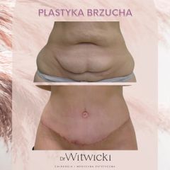 Plastyka brzucha - Artisan Clinic