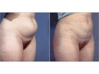 Liposukcja - przed i po