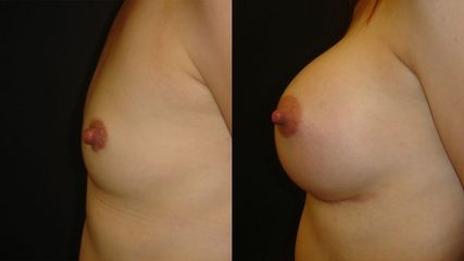 powiekszanie-piersi-18-1024x576