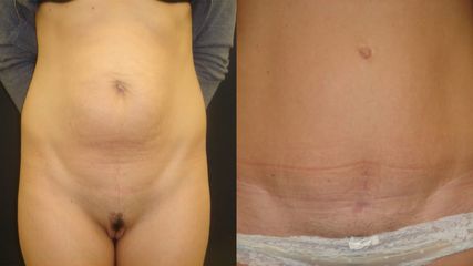 liposukcja-21-1024x576