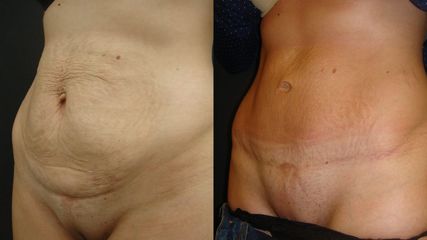 liposukcja-41-1024x576