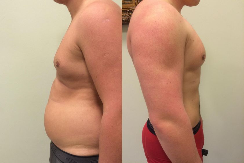 Liposukcja ultradźwiękowa przed i po - 654444